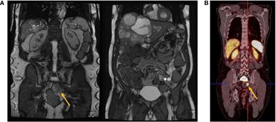 Multicenter Analysis of Presacral Neuroendocrine Neoplasms—Clinicopathological Characterization and Treatment Outcomes of a Rare Disease